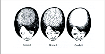 Ludwig Scale of female hair loss.