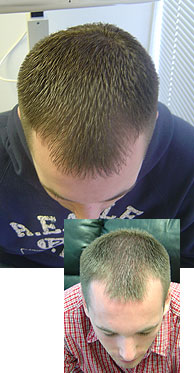 Men's Laser Hair Treatment Therapy - Moline, Illinois - Davenport, Iowa